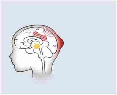 新生兒頭顱血腫
