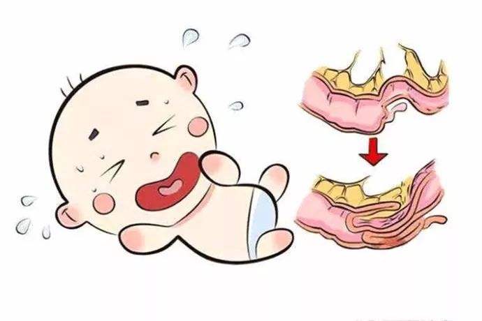 小兒腸套疊