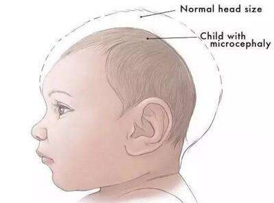 腦發(fā)育不良