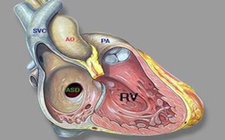 小兒房間隔缺損