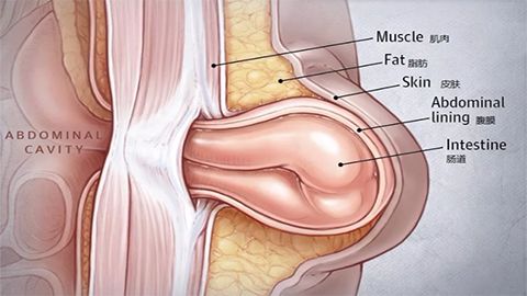 新生兒臍疝