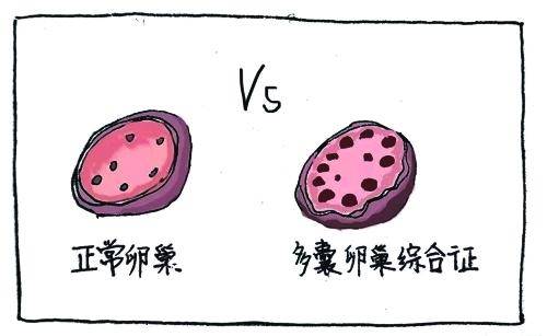 多囊卵巢綜合征