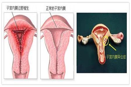 子宮內(nèi)膜增生