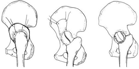 髖關(guān)節(jié)結(jié)核