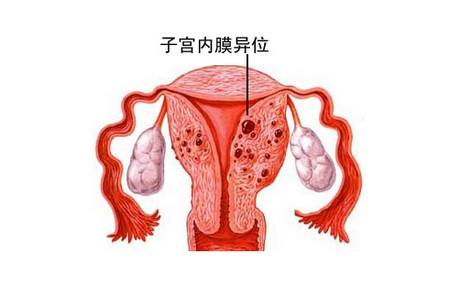 子宮內(nèi)膜異位癥