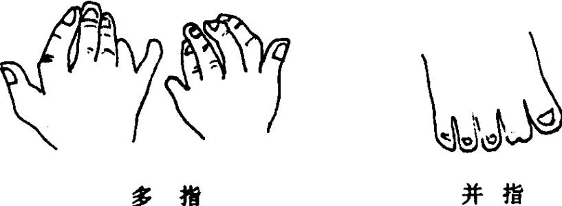 多指畸形