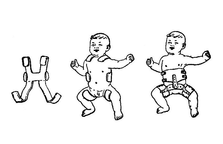 髖關(guān)節(jié)脫位