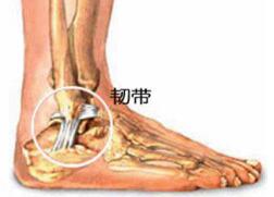 韌帶拉傷