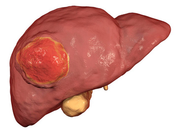 肝細(xì)胞癌